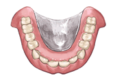チタン床義歯